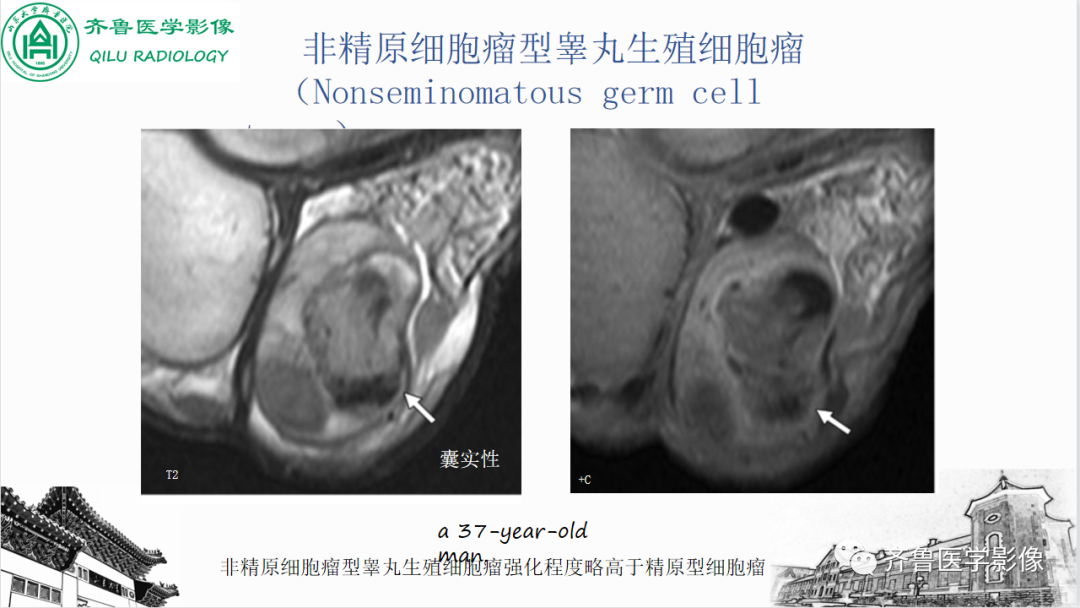 影像PPT - 【PPT】男性生殖系统疾病（睾丸扭转）-38
