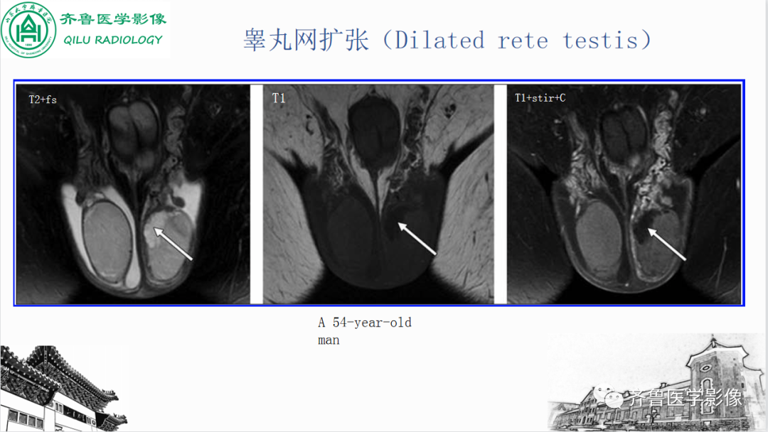 影像PPT - 【PPT】男性生殖系统疾病（睾丸扭转）-33