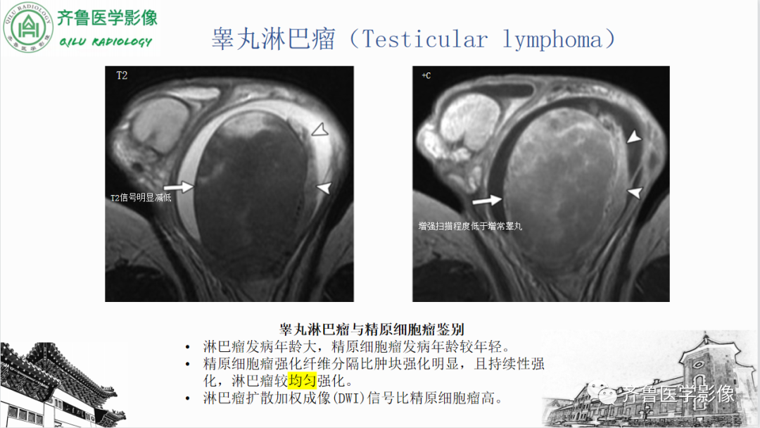 影像PPT - 【PPT】男性生殖系统疾病（睾丸扭转）-36