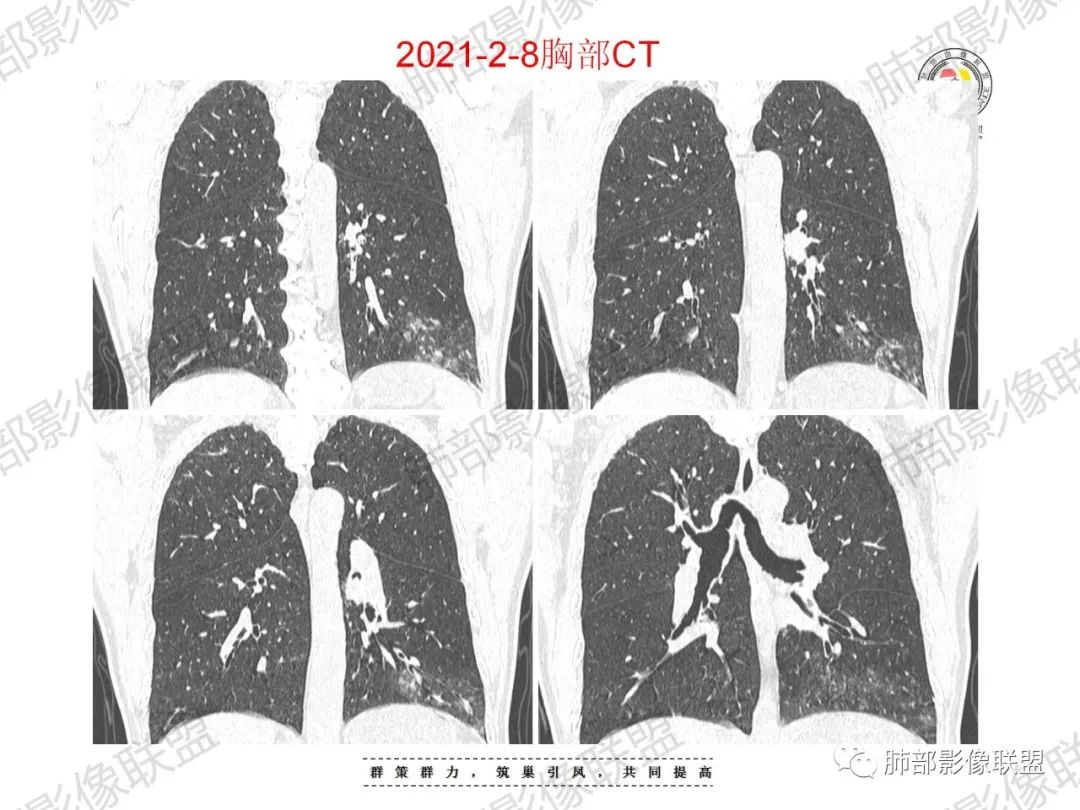 影像PPT - 【病例】重视肺部的那些小花小草-4 影像PPT - 【病例】重视肺部的那些小花小草-4