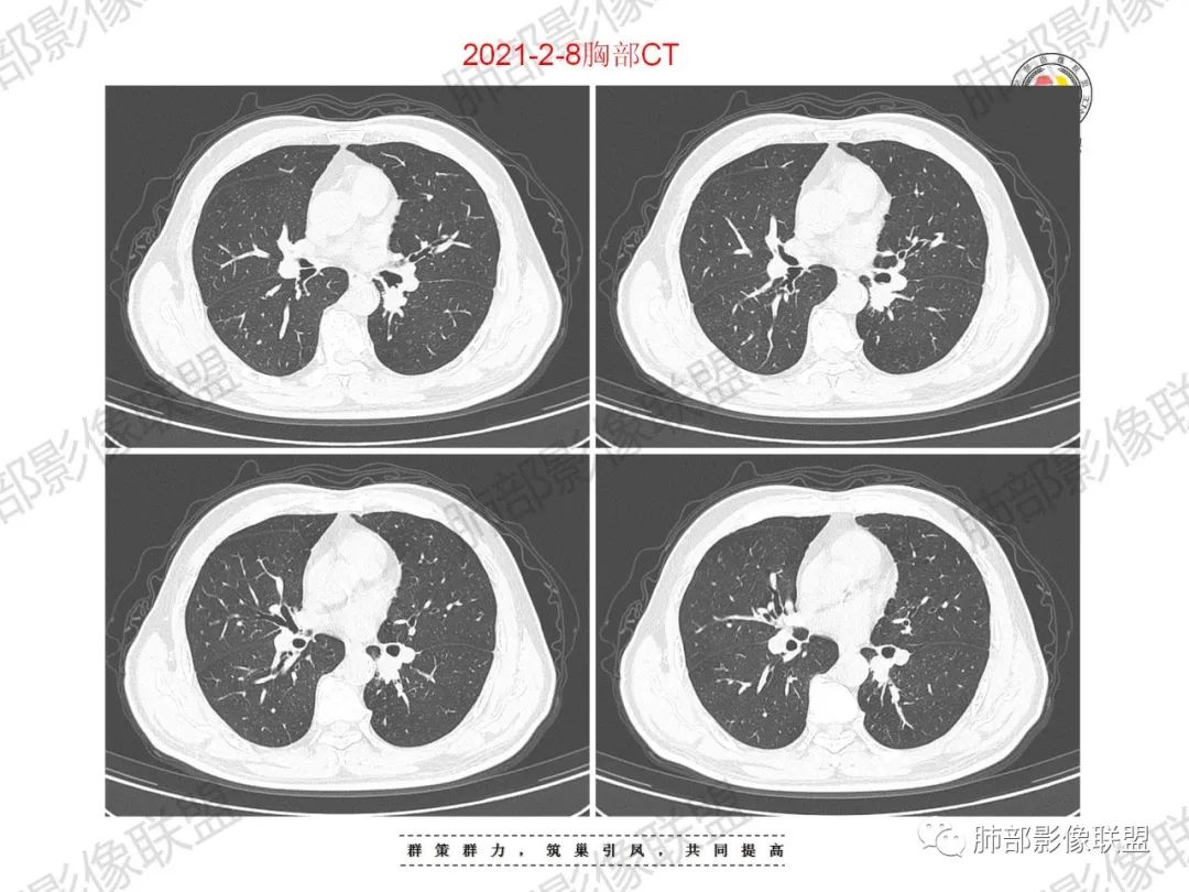 影像PPT - 【病例】重视肺部的那些小花小草-6 影像PPT - 【病例】重视肺部的那些小花小草-6