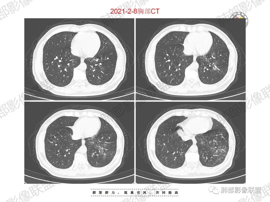 影像PPT - 【病例】重视肺部的那些小花小草-8 影像PPT - 【病例】重视肺部的那些小花小草-8