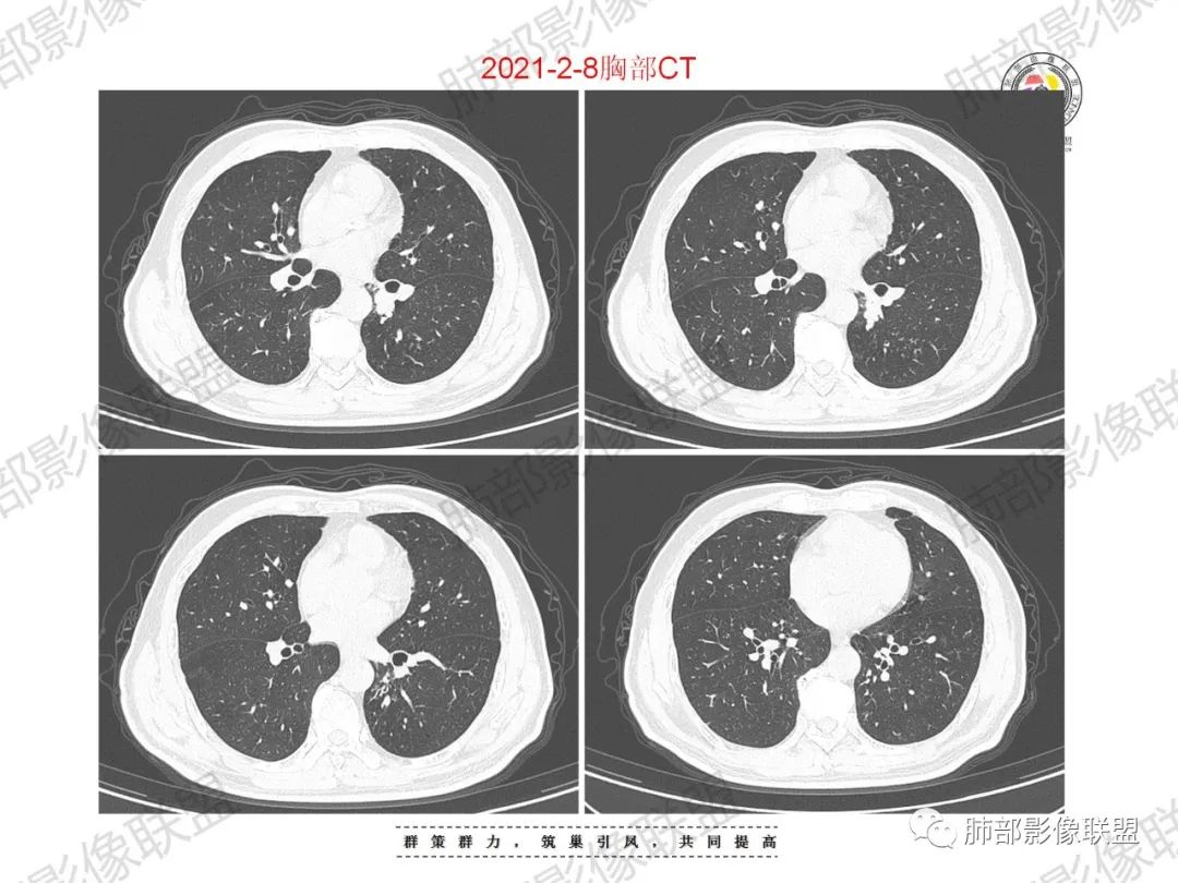 影像PPT - 【病例】重视肺部的那些小花小草-7 影像PPT - 【病例】重视肺部的那些小花小草-7