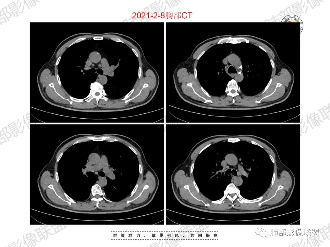 影像PPT - 【病例】重视肺部的那些小花小草-9 影像PPT - 【病例】重视肺部的那些小花小草-9