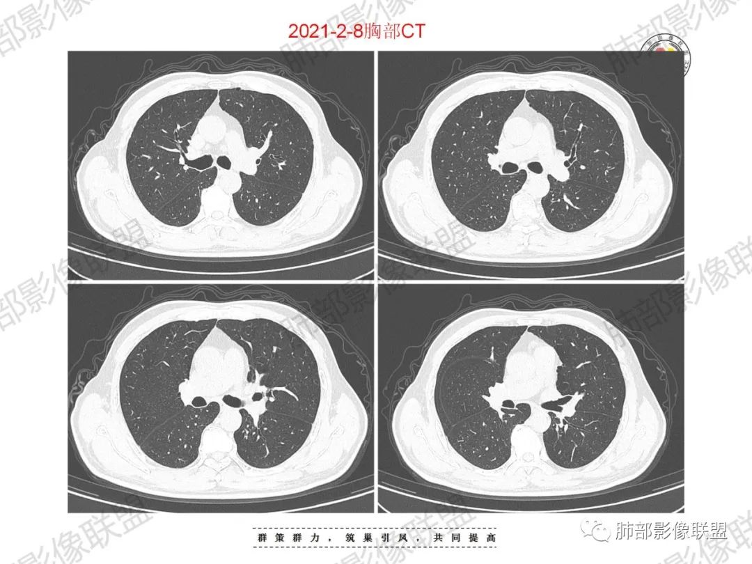 影像PPT - 【病例】重视肺部的那些小花小草-5 影像PPT - 【病例】重视肺部的那些小花小草-5
