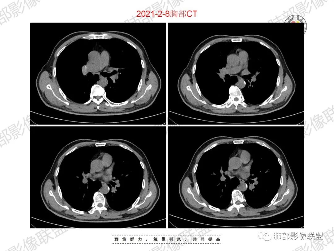 影像PPT - 【病例】重视肺部的那些小花小草-10 影像PPT - 【病例】重视肺部的那些小花小草-10