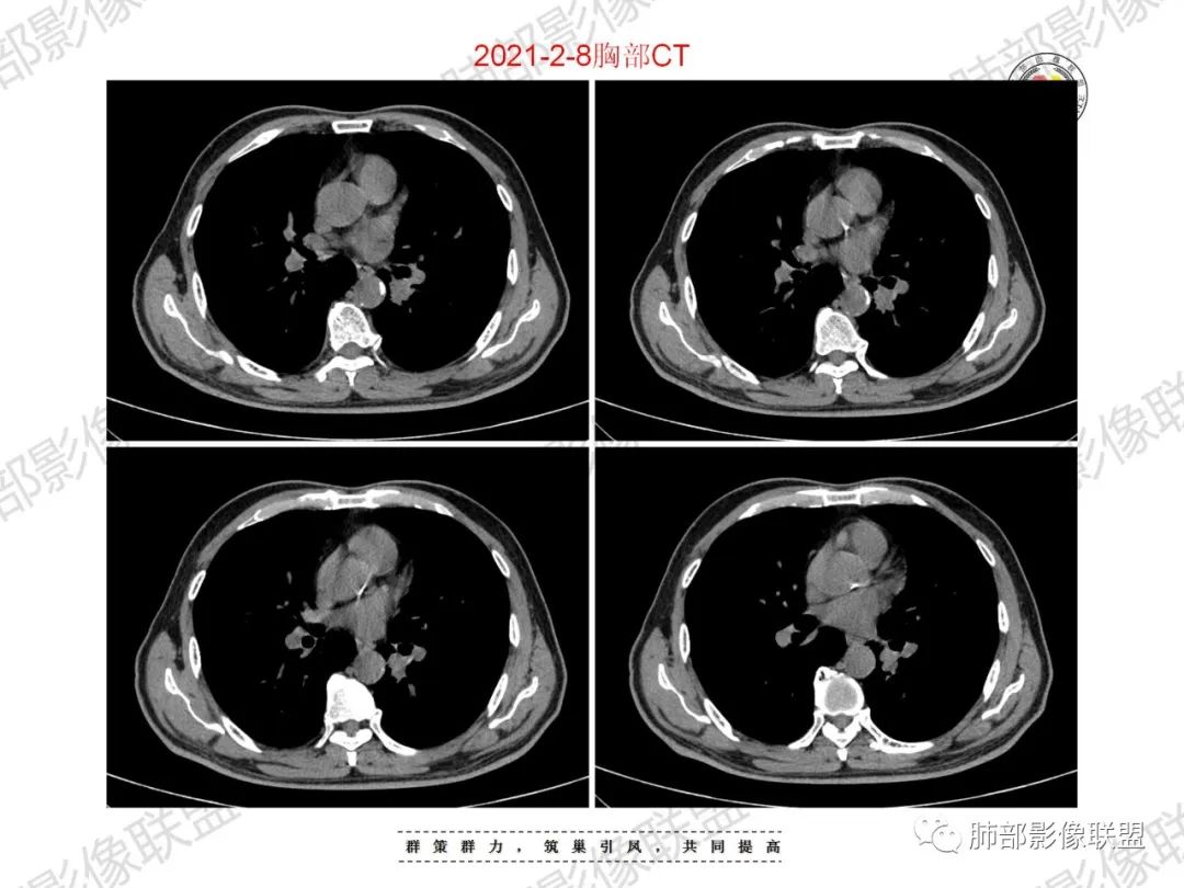 影像PPT - 【病例】重视肺部的那些小花小草-11 影像PPT - 【病例】重视肺部的那些小花小草-11