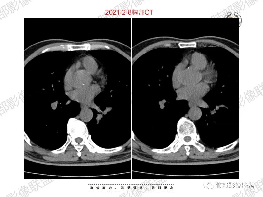 影像PPT - 【病例】重视肺部的那些小花小草-12 影像PPT - 【病例】重视肺部的那些小花小草-12