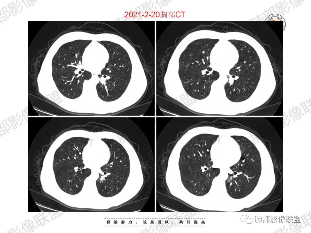 影像PPT - 【病例】重视肺部的那些小花小草-15 影像PPT - 【病例】重视肺部的那些小花小草-15