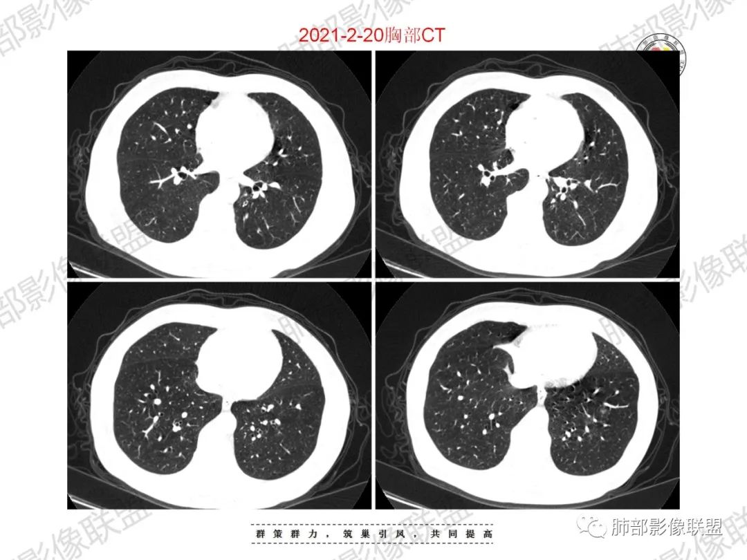 影像PPT - 【病例】重视肺部的那些小花小草-16 影像PPT - 【病例】重视肺部的那些小花小草-16