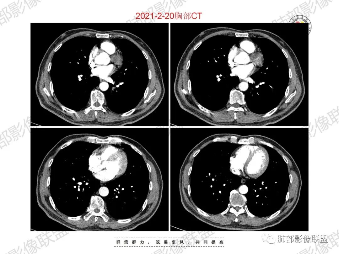 影像PPT - 【病例】重视肺部的那些小花小草-22 影像PPT - 【病例】重视肺部的那些小花小草-22