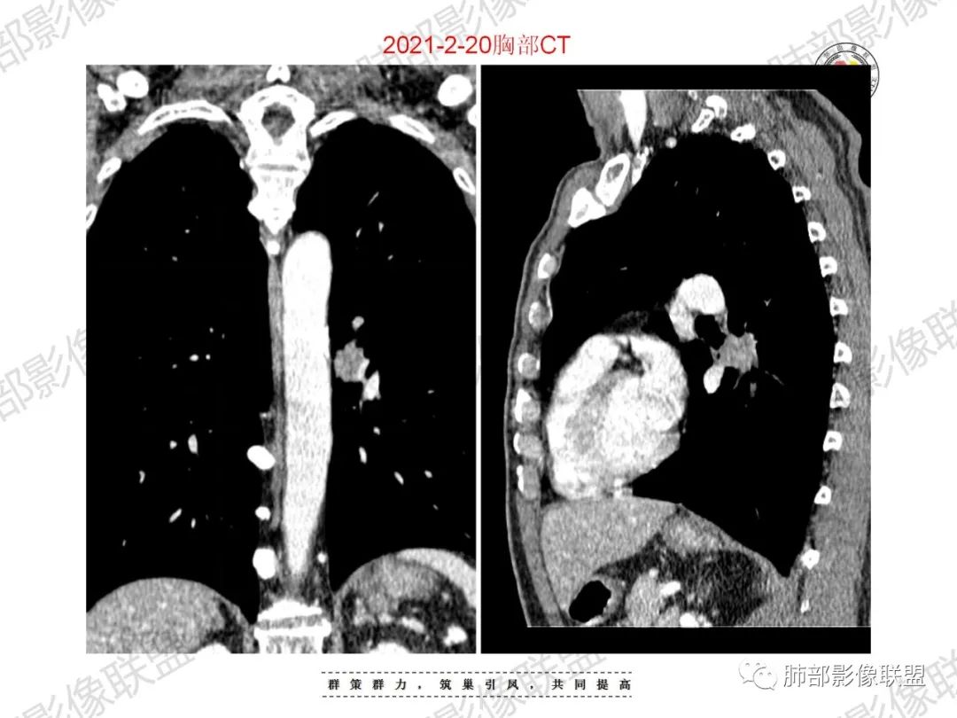 影像PPT - 【病例】重视肺部的那些小花小草-23 影像PPT - 【病例】重视肺部的那些小花小草-23