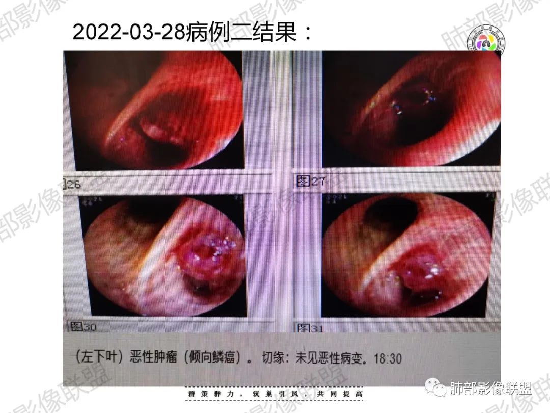 影像PPT - 【病例】重视肺部的那些小花小草-30 影像PPT - 【病例】重视肺部的那些小花小草-30