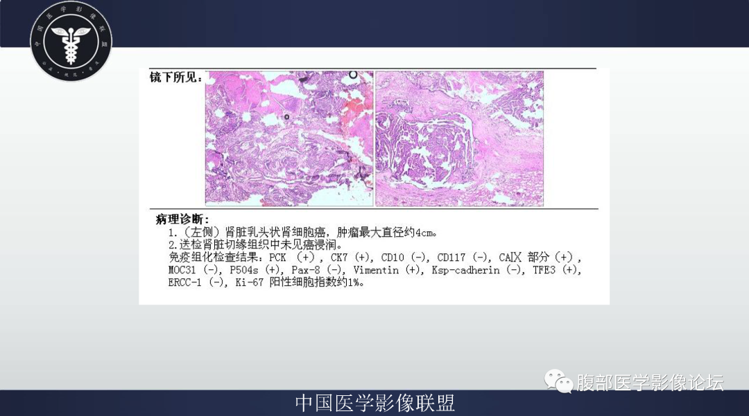 影像PPT - 【病例】肾脏乳头状肾细胞癌1例CT及MR-4
