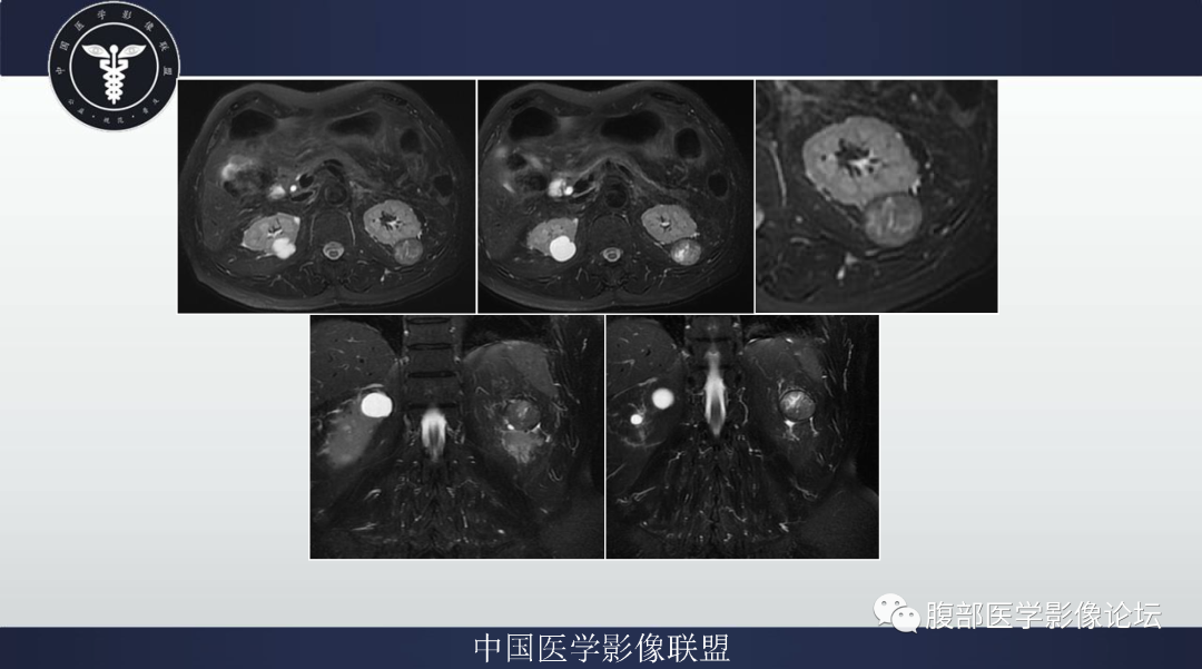影像PPT - 【病例】肾脏乳头状肾细胞癌1例CT及MR-2