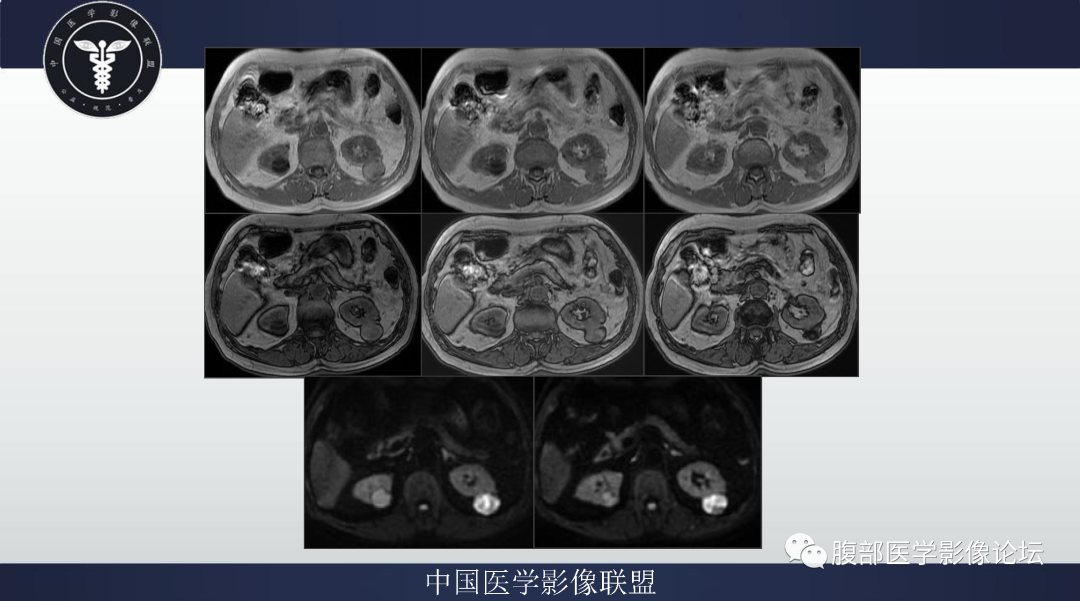 影像PPT - 【病例】肾脏乳头状肾细胞癌1例CT及MR-3