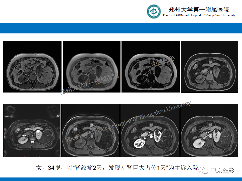 影像PPT - 【病例】肾脏乳头状肾细胞癌1例CT及MR-14