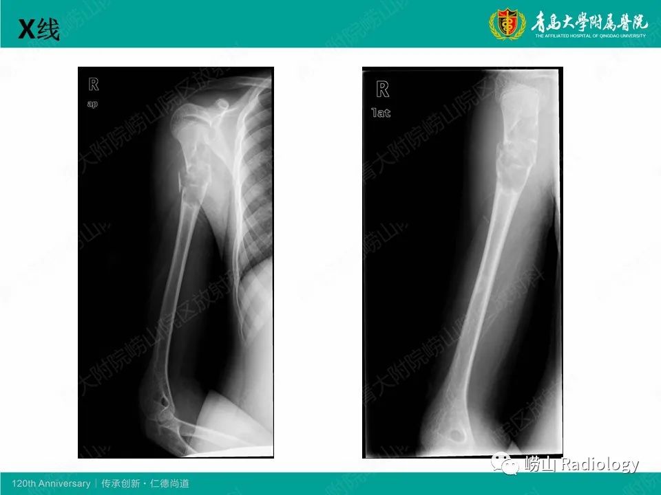 影像PPT - 【病例】非骨化性纤维瘤1例X线CT及MR影像-3