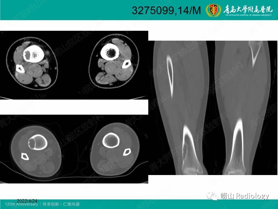 影像PPT - 【病例】非骨化性纤维瘤1例X线CT及MR影像-14