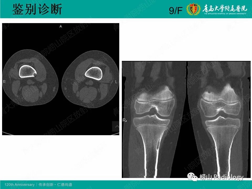 影像PPT - 【病例】非骨化性纤维瘤1例X线CT及MR影像-16
