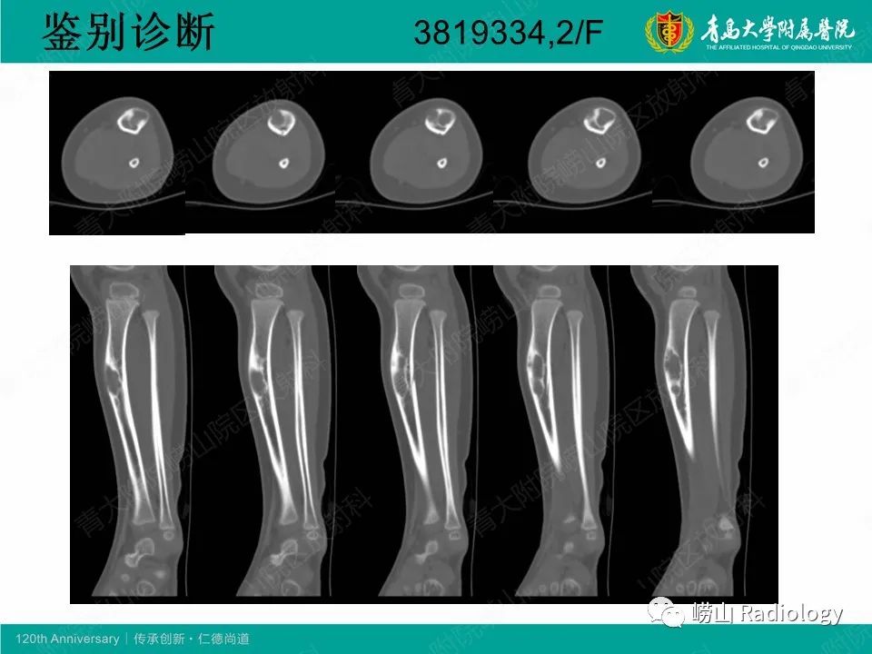 影像PPT - 【病例】非骨化性纤维瘤1例X线CT及MR影像-20