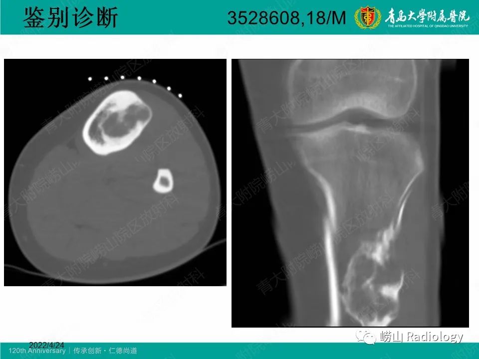 影像PPT - 【病例】非骨化性纤维瘤1例X线CT及MR影像-21