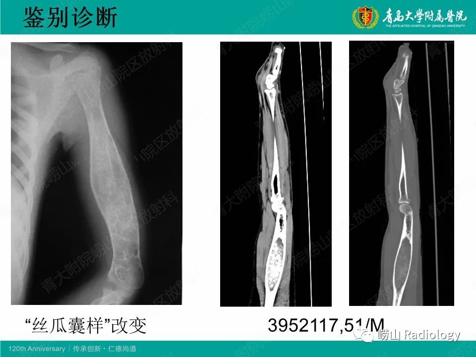 影像PPT - 【病例】非骨化性纤维瘤1例X线CT及MR影像-25