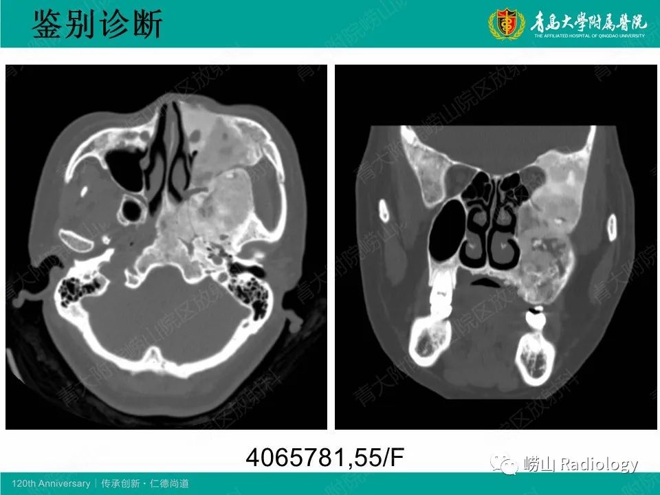 影像PPT - 【病例】非骨化性纤维瘤1例X线CT及MR影像-26