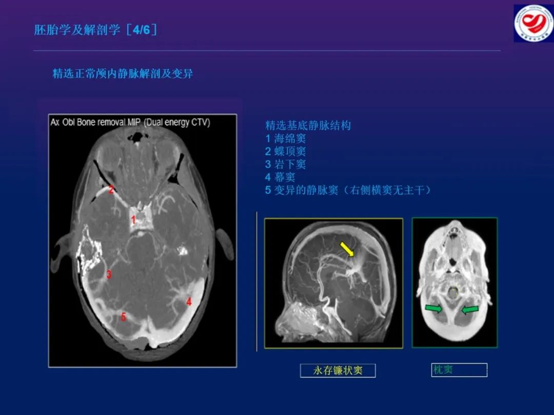 影像PPT - 【PPT】小儿脑静脉影像学：包括硬脑膜静脉窦-6
