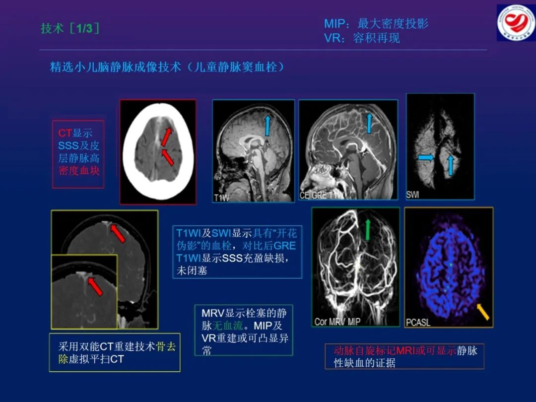 影像PPT - 【PPT】小儿脑静脉影像学：包括硬脑膜静脉窦-9