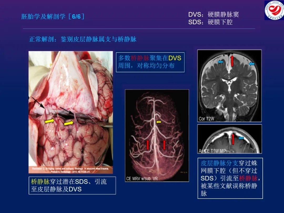 影像PPT - 【PPT】小儿脑静脉影像学：包括硬脑膜静脉窦-8