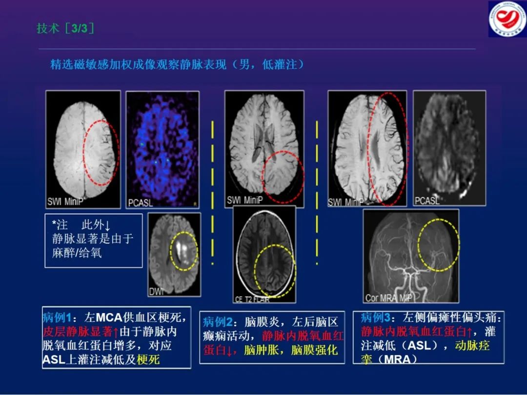 影像PPT - 【PPT】小儿脑静脉影像学：包括硬脑膜静脉窦-11