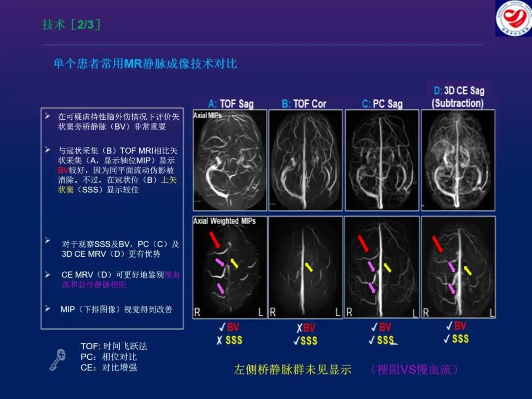 影像PPT - 【PPT】小儿脑静脉影像学：包括硬脑膜静脉窦-10