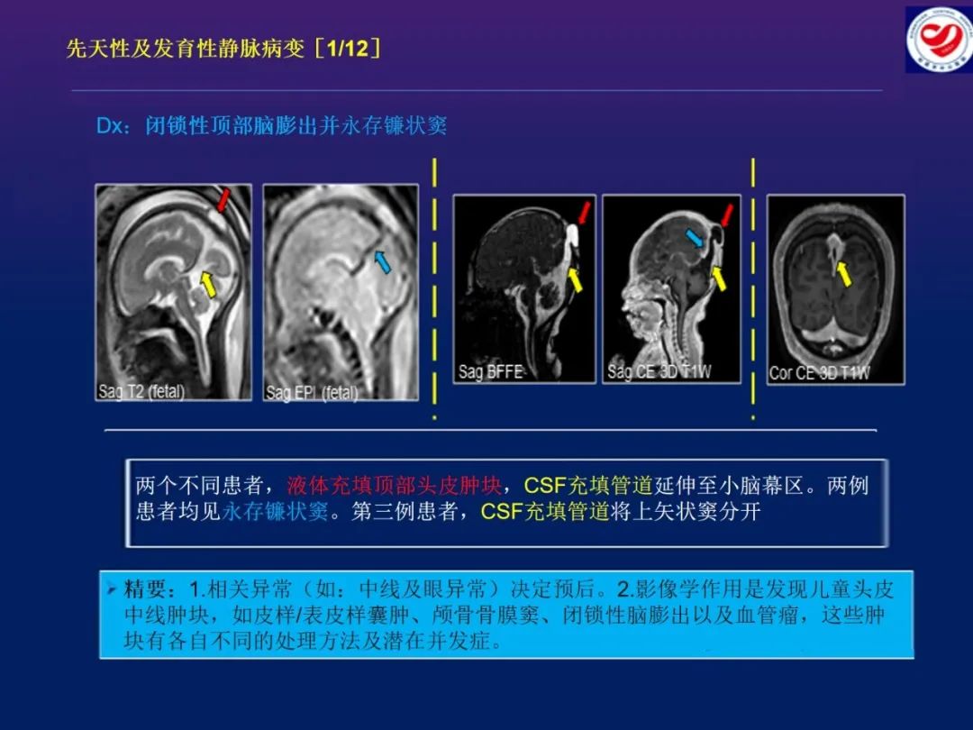 影像PPT - 【PPT】小儿脑静脉影像学：包括硬脑膜静脉窦-12