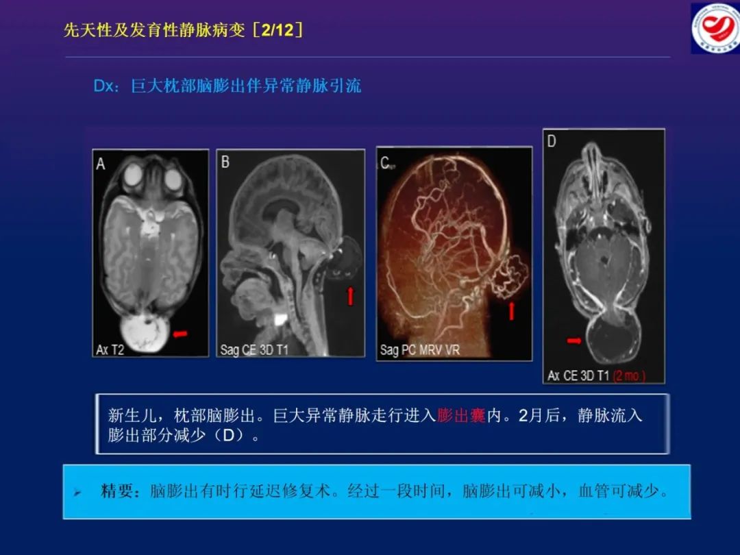 影像PPT - 【PPT】小儿脑静脉影像学：包括硬脑膜静脉窦-13