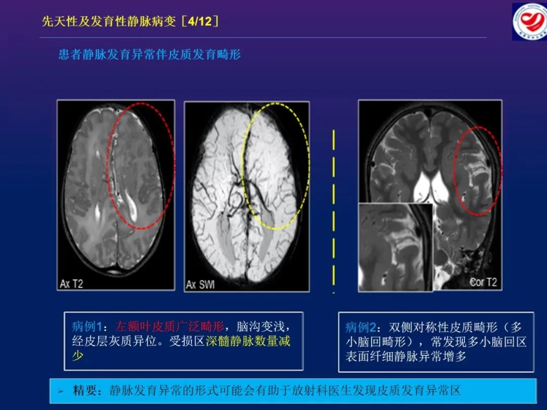 影像PPT - 【PPT】小儿脑静脉影像学：包括硬脑膜静脉窦-15