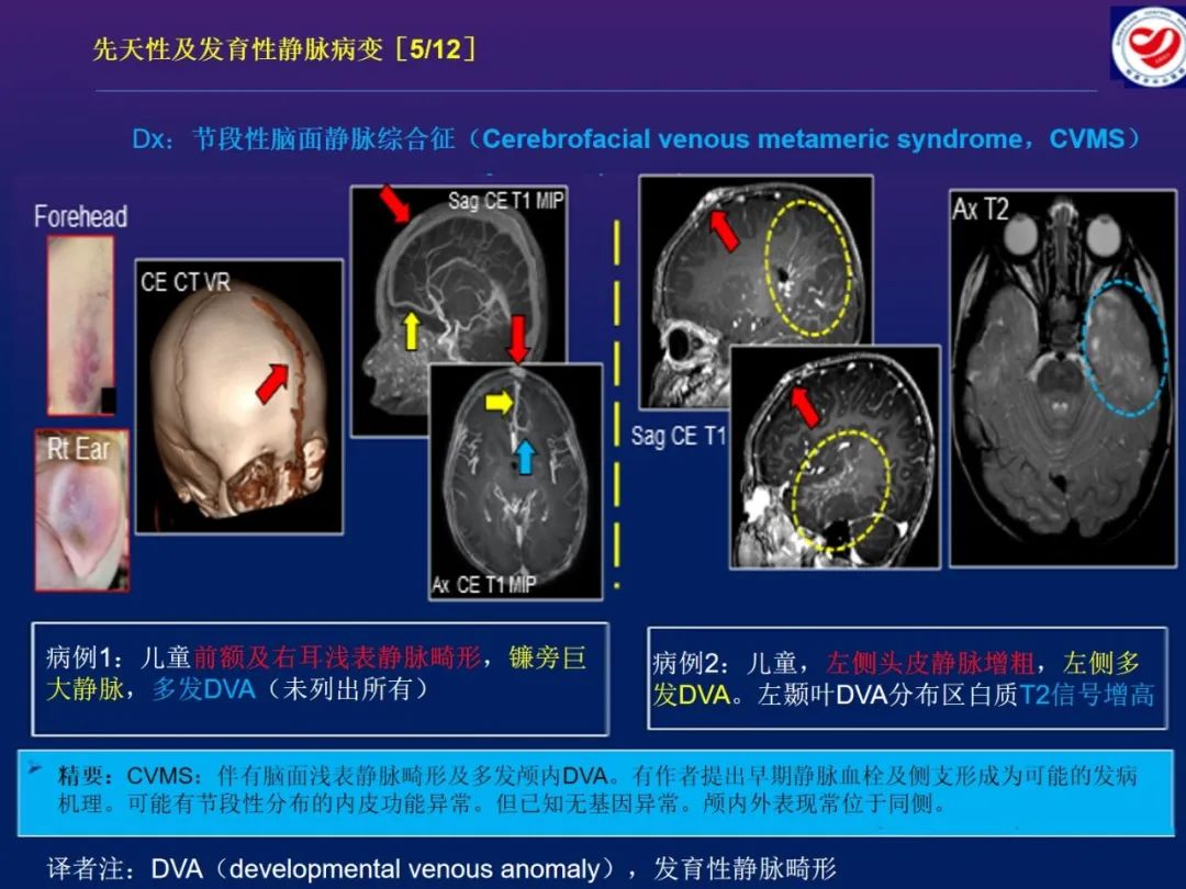 影像PPT - 【PPT】小儿脑静脉影像学：包括硬脑膜静脉窦-16