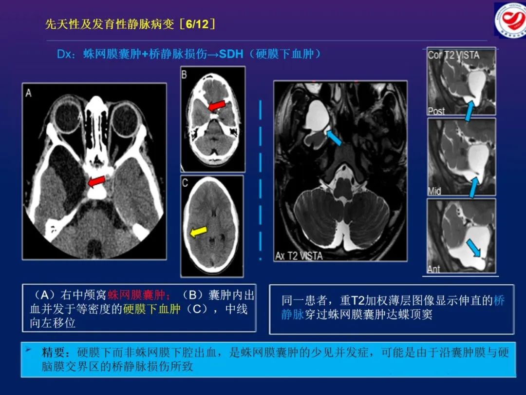 影像PPT - 【PPT】小儿脑静脉影像学：包括硬脑膜静脉窦-17