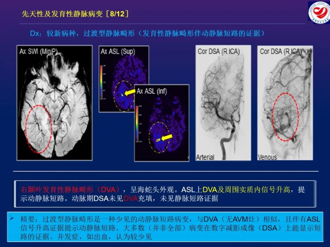 影像PPT - 【PPT】小儿脑静脉影像学：包括硬脑膜静脉窦-19