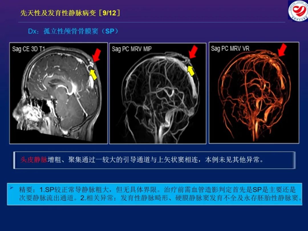 影像PPT - 【PPT】小儿脑静脉影像学：包括硬脑膜静脉窦-20