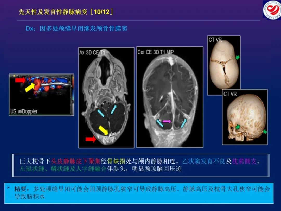 影像PPT - 【PPT】小儿脑静脉影像学：包括硬脑膜静脉窦-21