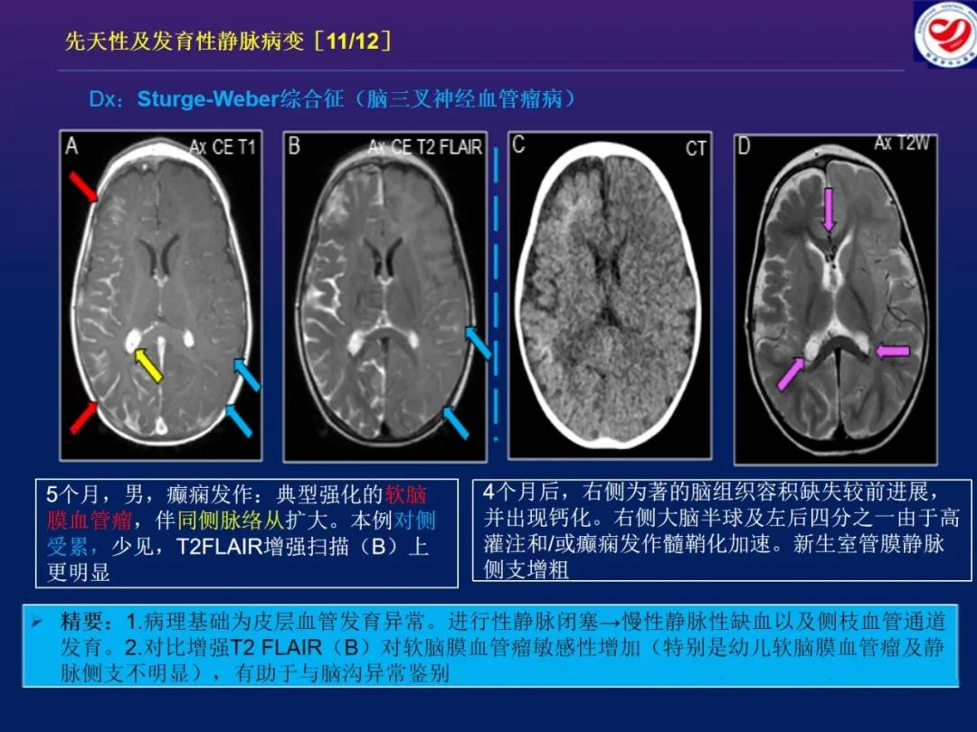 影像PPT - 【PPT】小儿脑静脉影像学：包括硬脑膜静脉窦-22