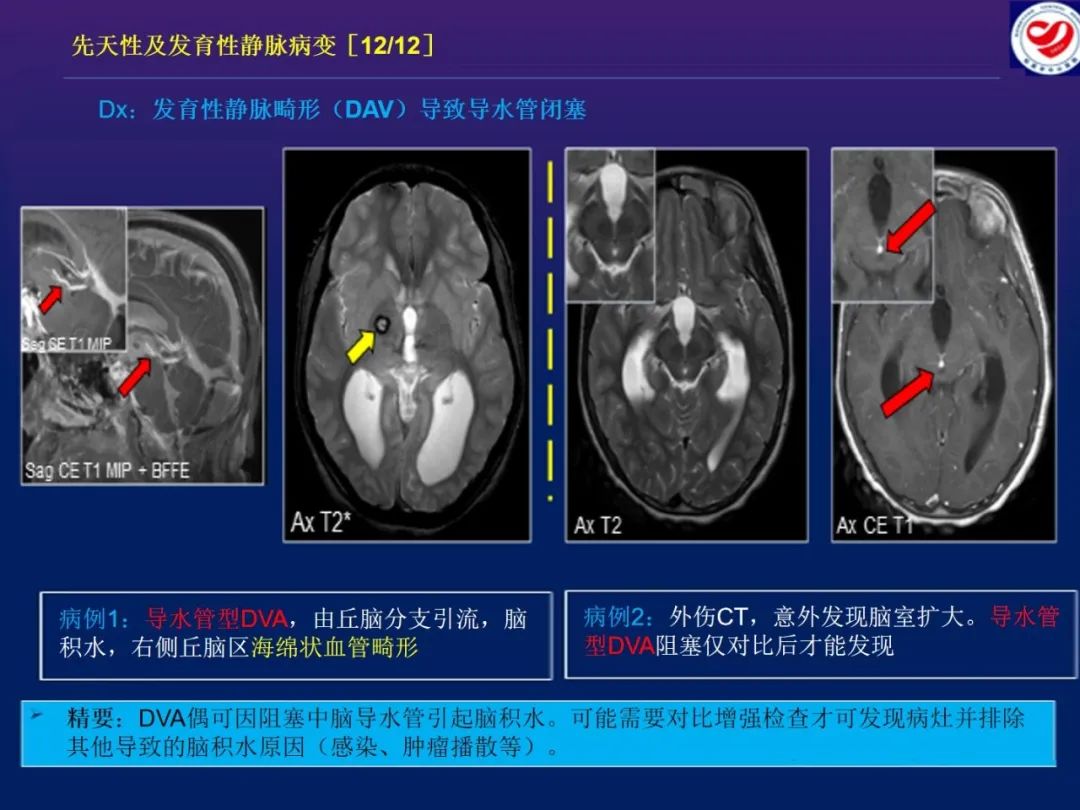 影像PPT - 【PPT】小儿脑静脉影像学：包括硬脑膜静脉窦-23