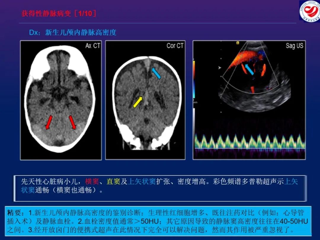 影像PPT - 【PPT】小儿脑静脉影像学：包括硬脑膜静脉窦-24