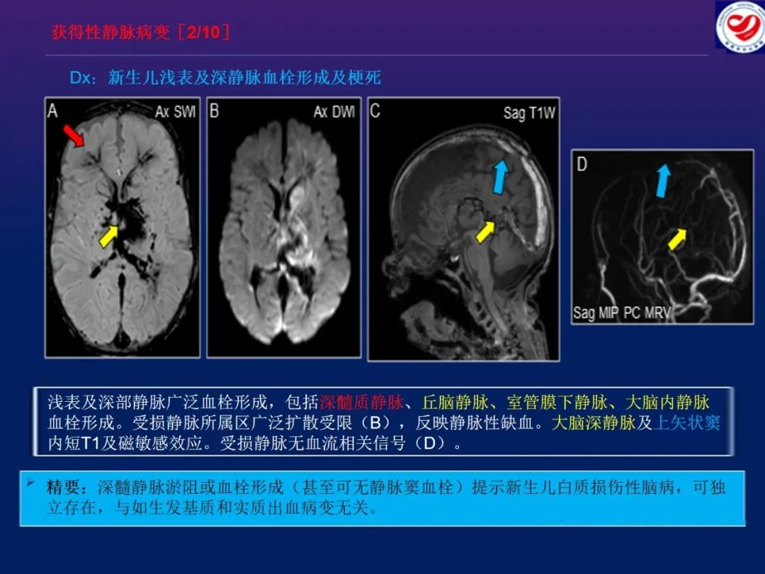 影像PPT - 【PPT】小儿脑静脉影像学：包括硬脑膜静脉窦-25