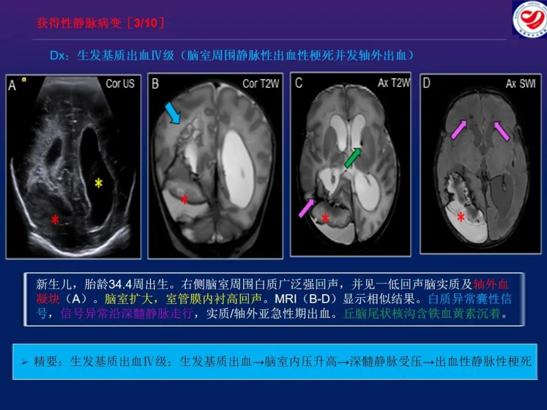 影像PPT - 【PPT】小儿脑静脉影像学：包括硬脑膜静脉窦-26