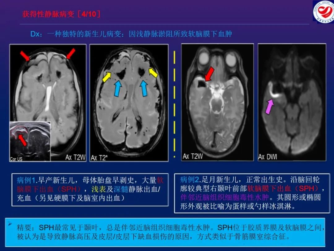 影像PPT - 【PPT】小儿脑静脉影像学：包括硬脑膜静脉窦-27
