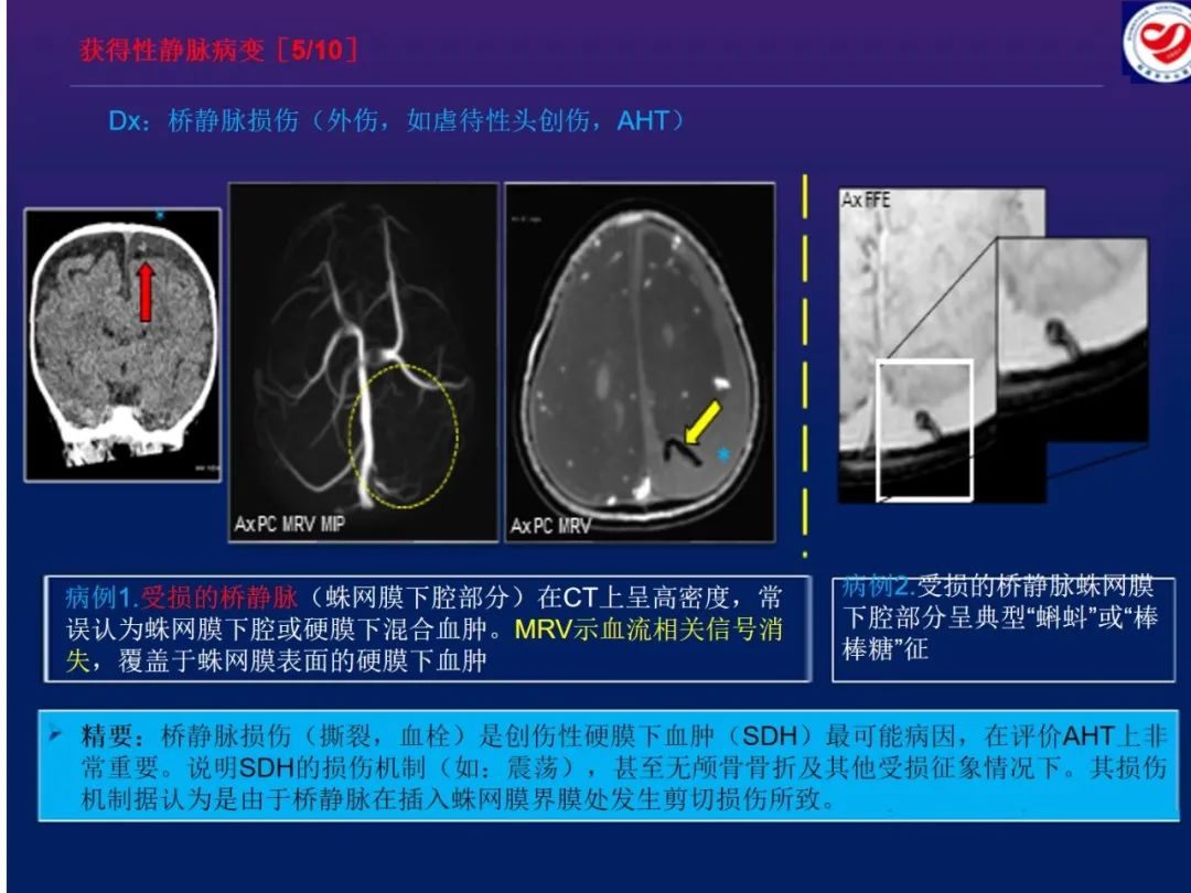 影像PPT - 【PPT】小儿脑静脉影像学：包括硬脑膜静脉窦-28