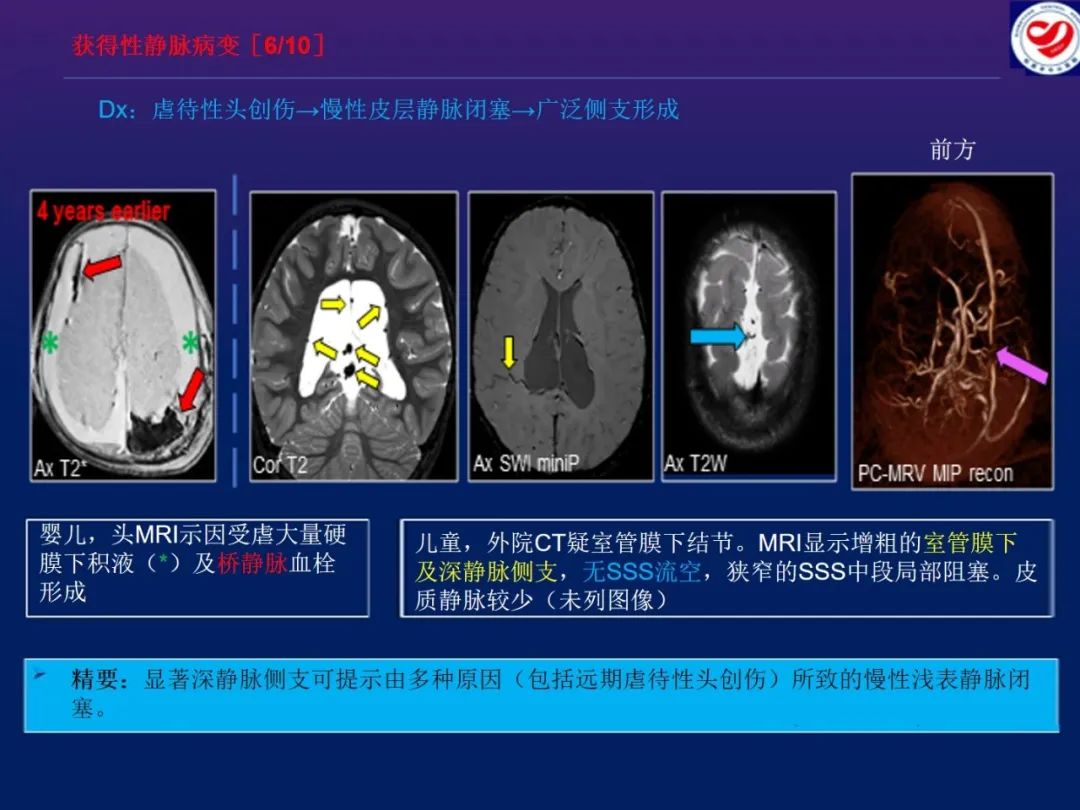 影像PPT - 【PPT】小儿脑静脉影像学：包括硬脑膜静脉窦-29