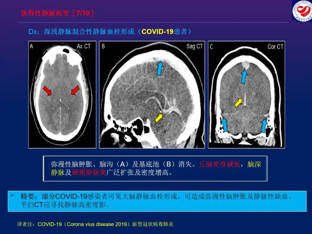 影像PPT - 【PPT】小儿脑静脉影像学：包括硬脑膜静脉窦-30